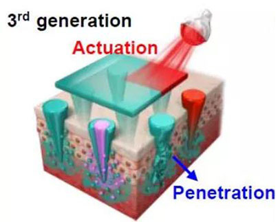 第三代：通过微针介导的皮肤层破坏和微针伴随的各种功能增强药物转运.jpg